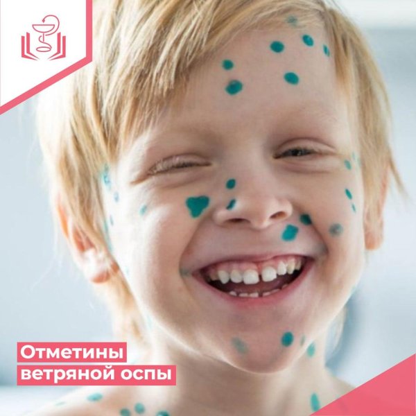 ветряная оспа