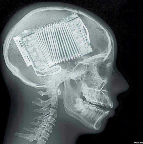 рентгенография черепа