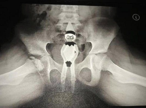 инородное тело прямой кишки