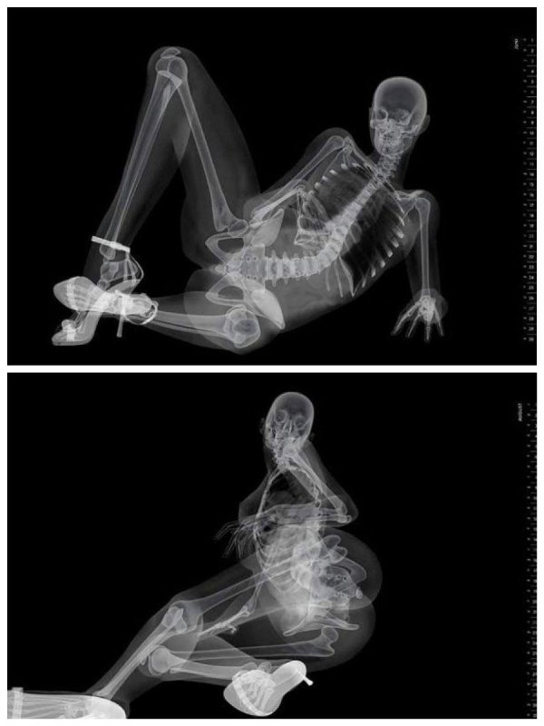 рентгеновский снимок