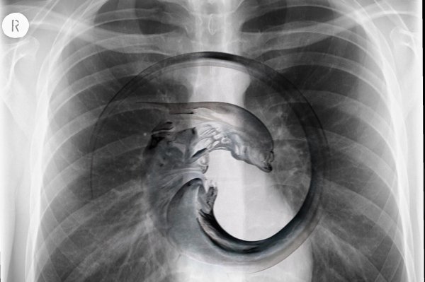 нормальный рентген огк