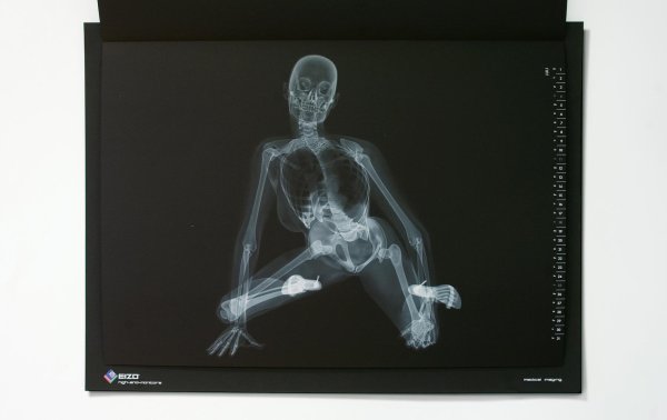 рентгеновский снимок человека