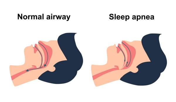 sleep apnea treatment