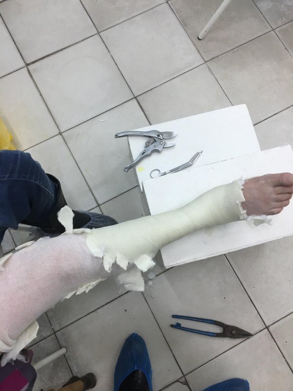 снятие гипса