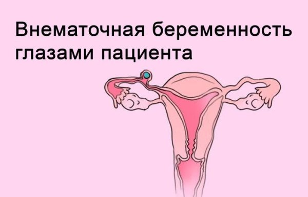 внематочная беременность