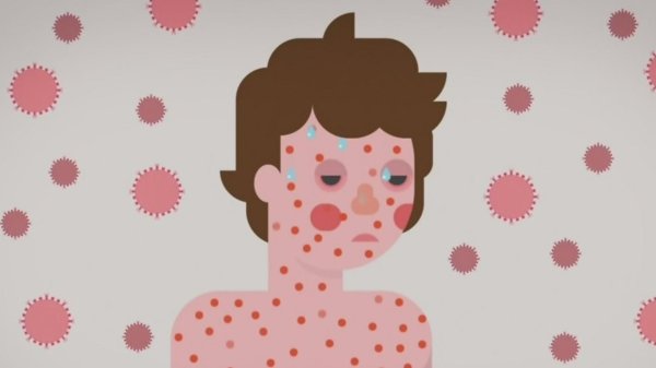 симптомы кори