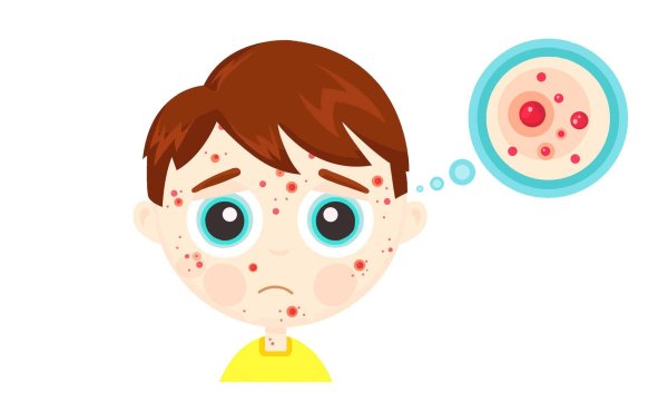 меры профилактики ветряной оспы