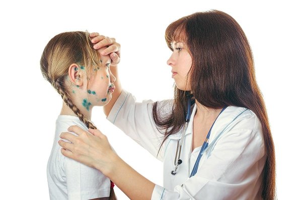 ветряная оспа