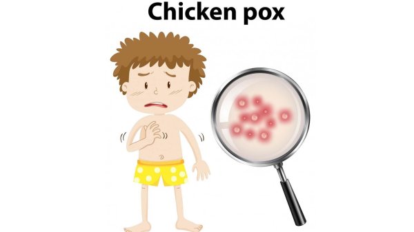 chickenpox treatment