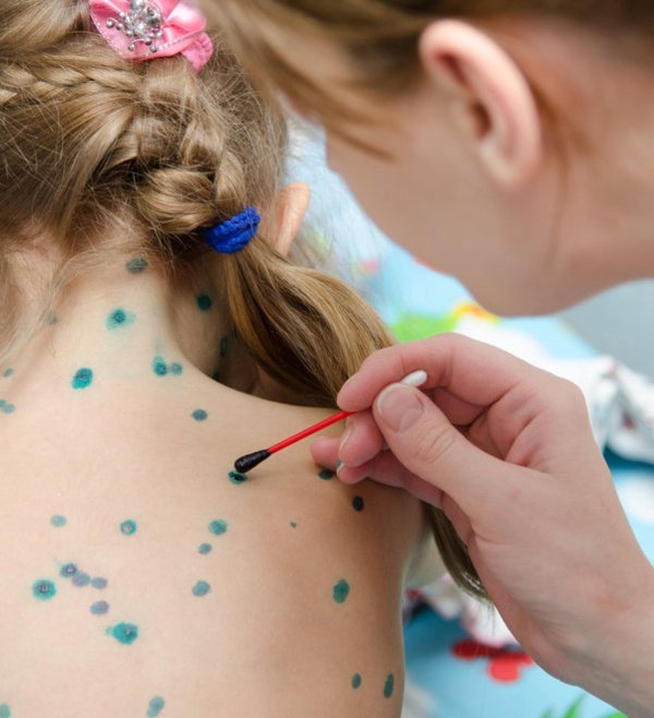 ветрянка у детей