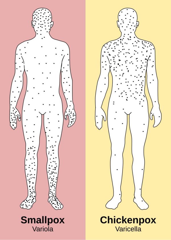 локализация сыпи