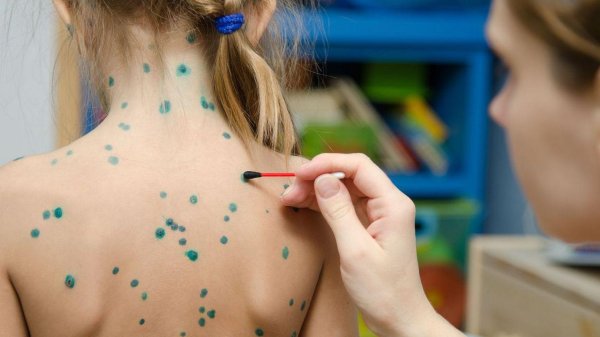 генерализированная ветрянка