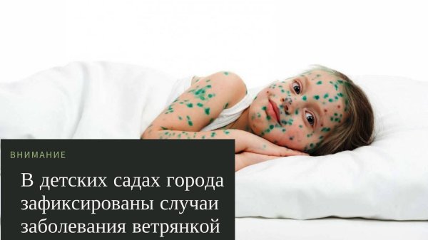 гангренозная ветрянка