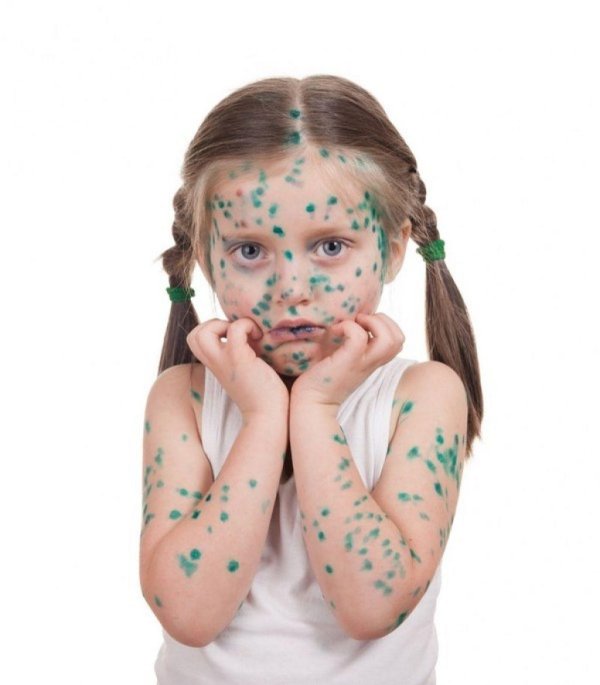 ветрянка у детей