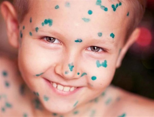 как выглядит ветрянка