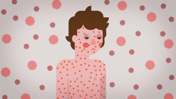 ветрянка у детей