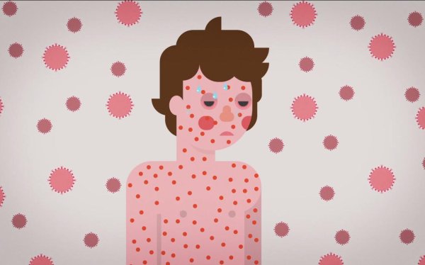 симптомы кори