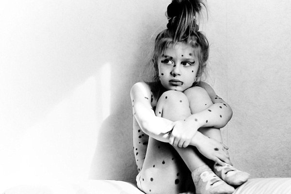 ветрянка у детей