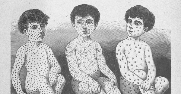 розеола скарлатина корь