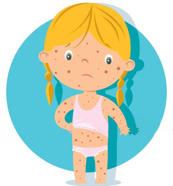 ветрянка рисунок