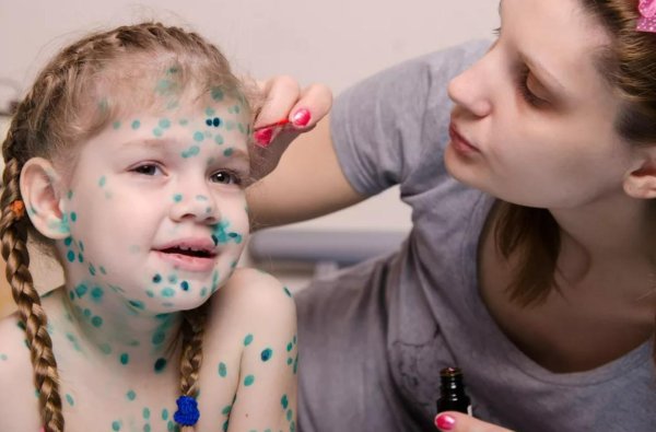 ветрянка зеленка