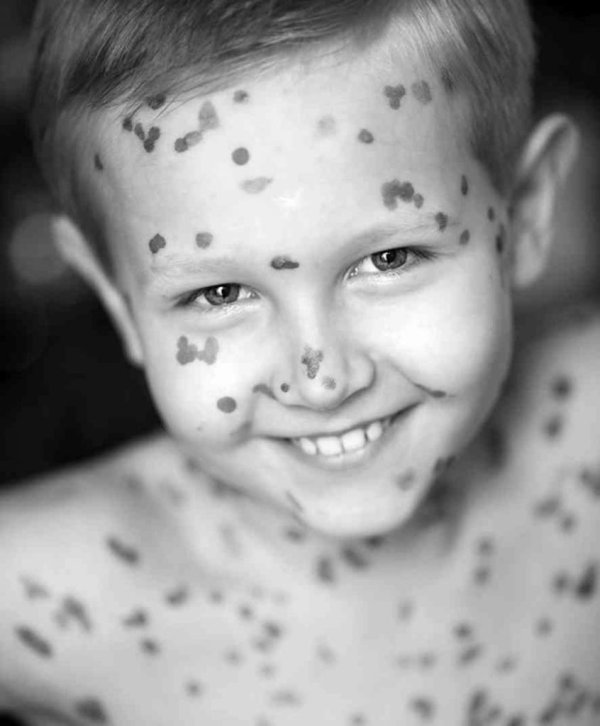 ветрянка заразность