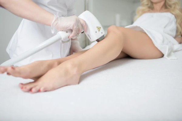 лазерная эпиляция