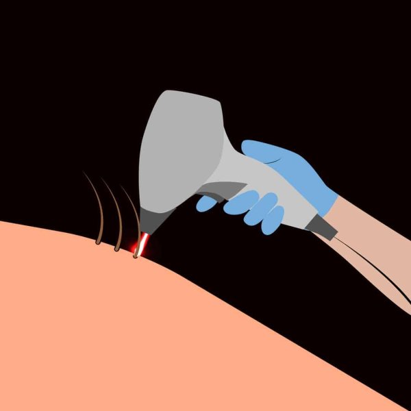 лазерная наноперфорация растяжек