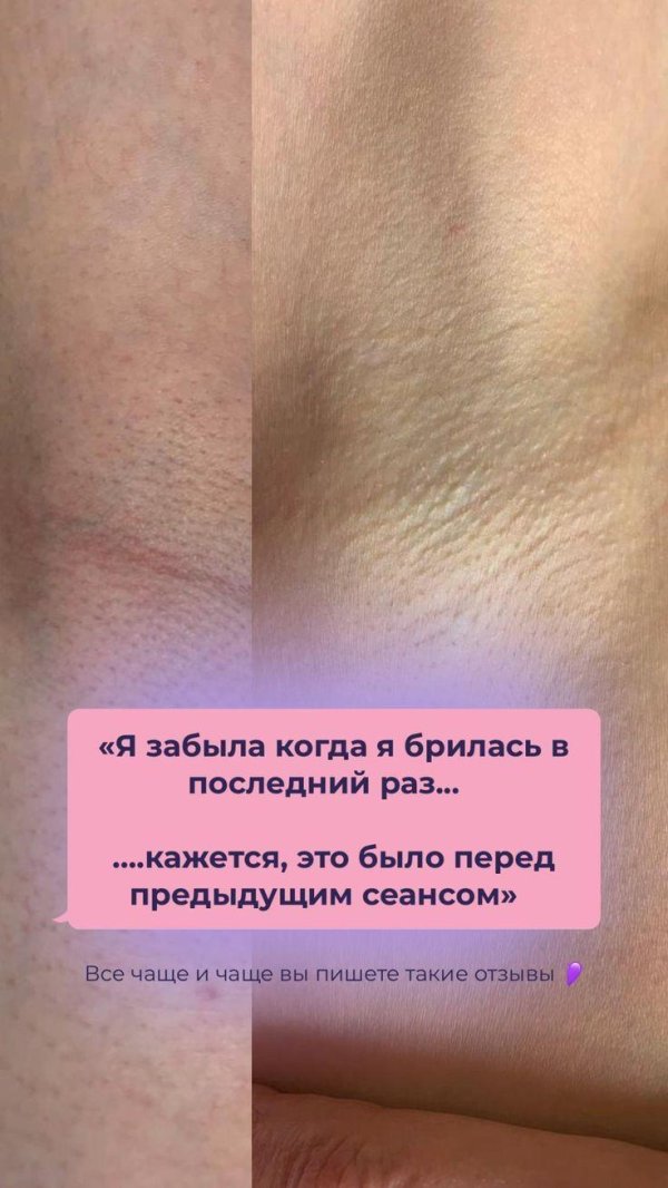 эпиляция зоны глубокого бикини