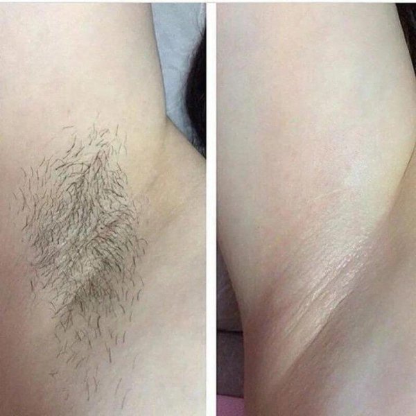 шугаринг глубокого бикини