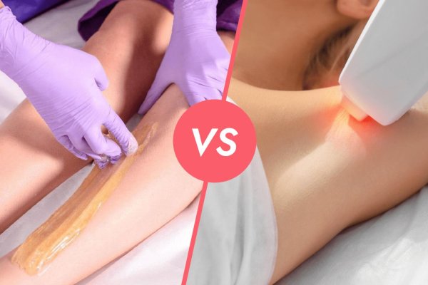 что лучше лазер или шугаринг