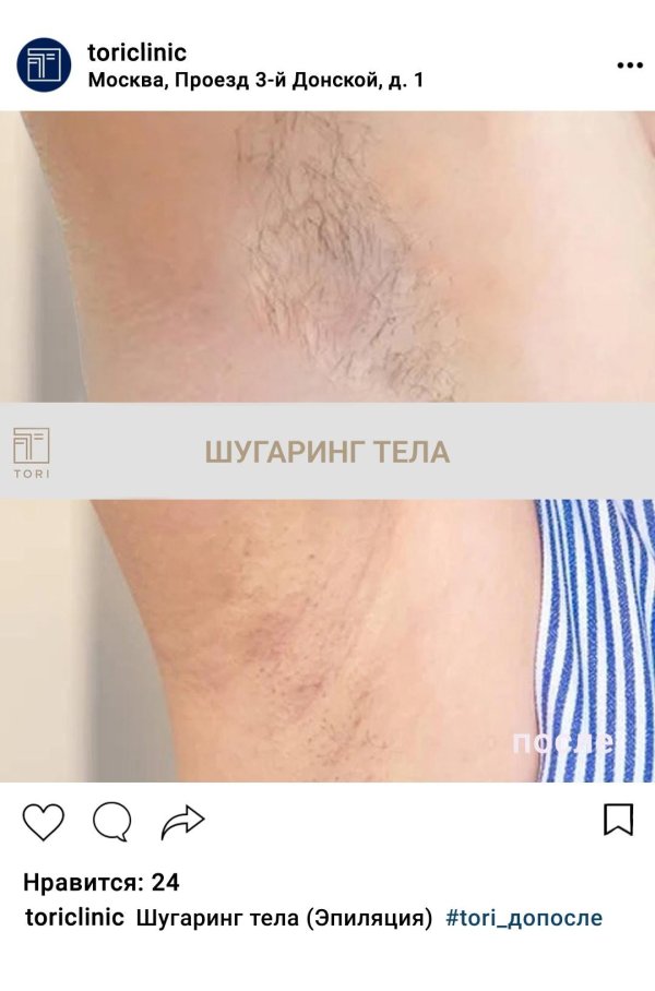 зоны шугаринга