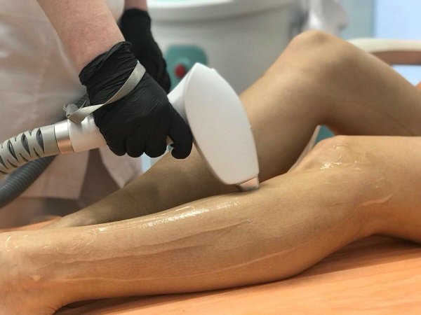 эпиляция лазером