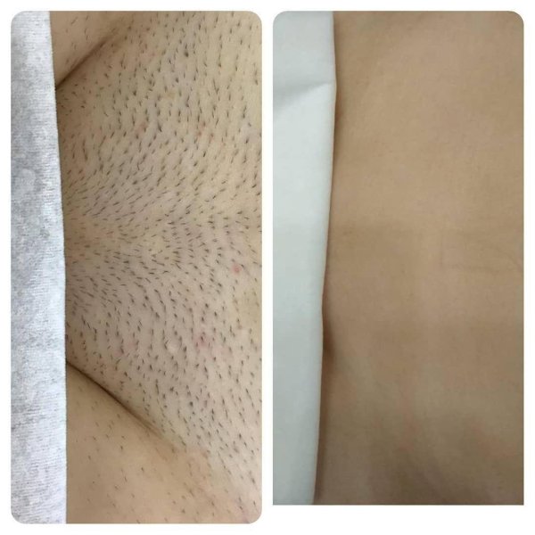 лазерная эпиляция бикини