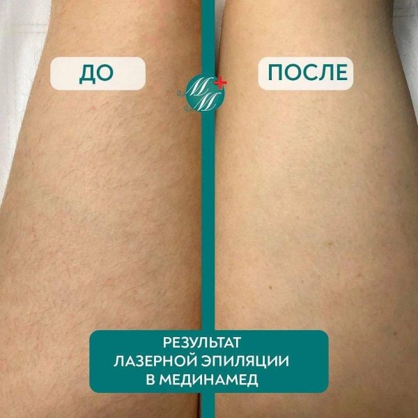 до и после лазерной эпиляции