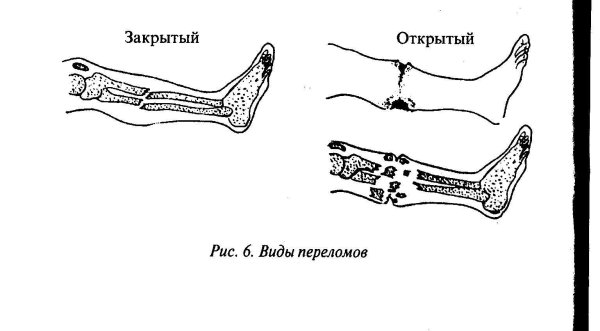 Перелом