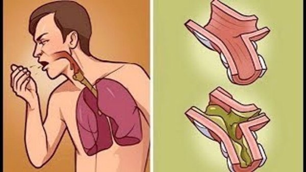 гнойный обструктивный бронхит