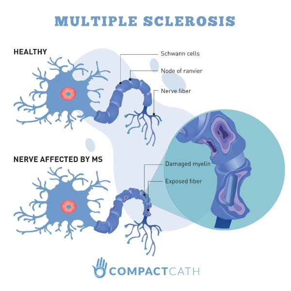 multiple sclerosis