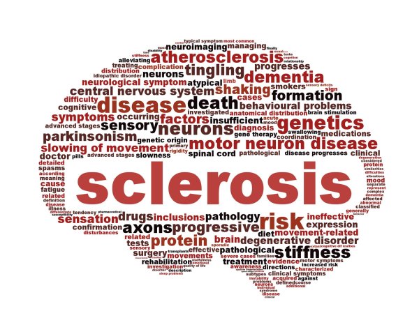 multiple sclerosis