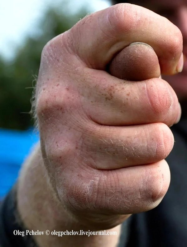 разбитый кулак