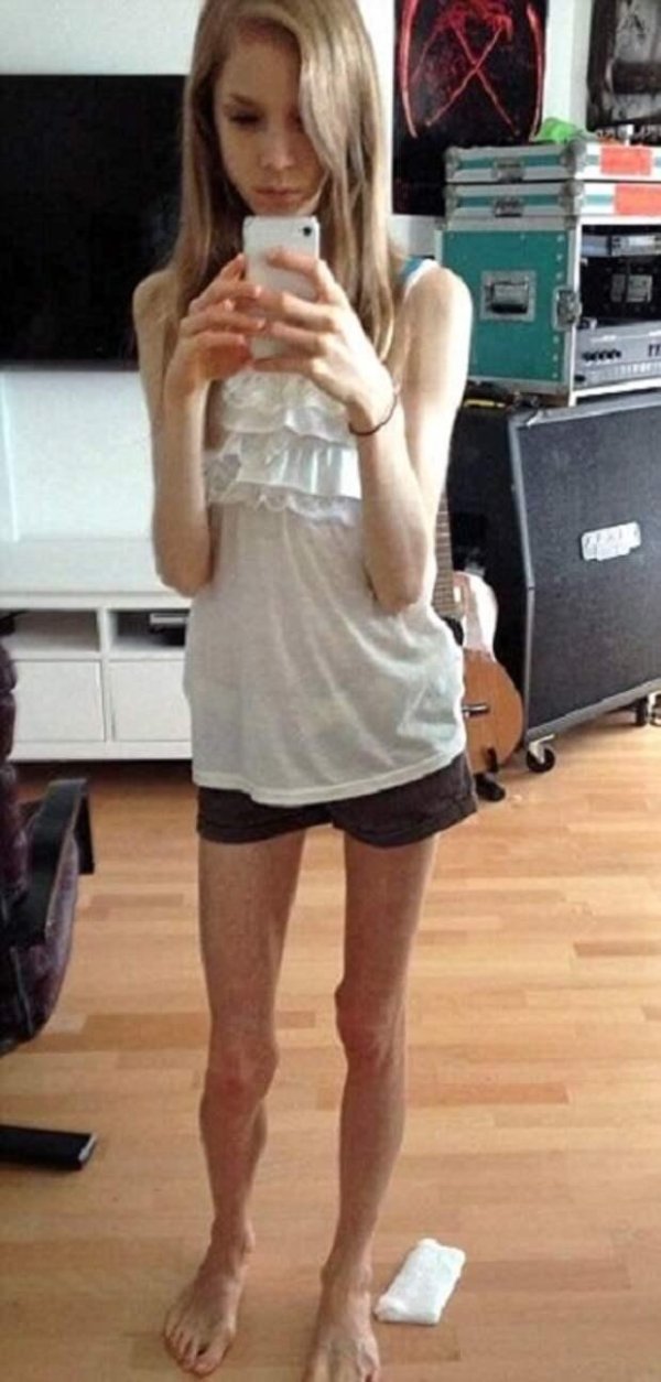 даша пархоменко анорексия