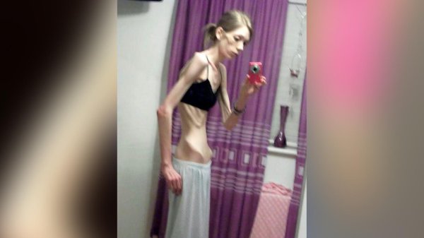 анорексичка дарья пархоменко