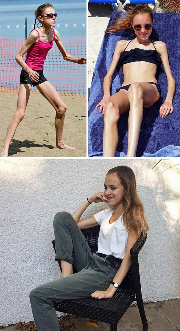 люди болеющие анорексией