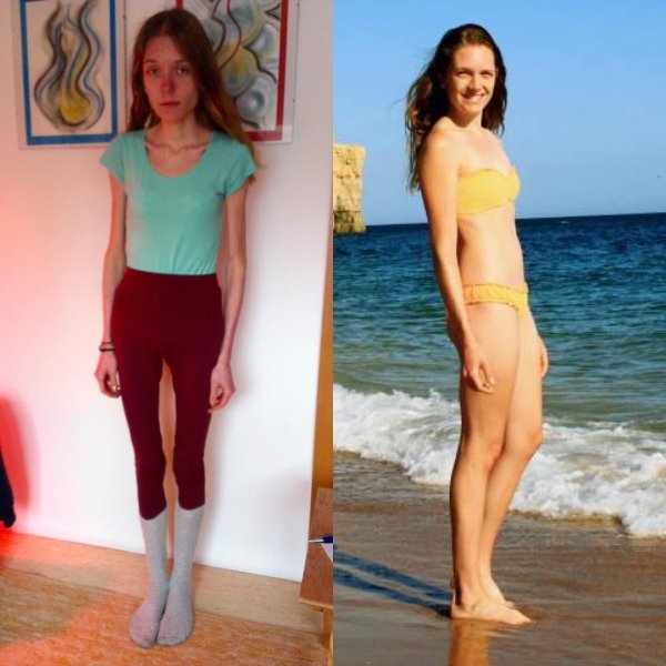 анорексия 30 кг