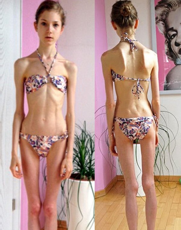 анна жолобова анорексия