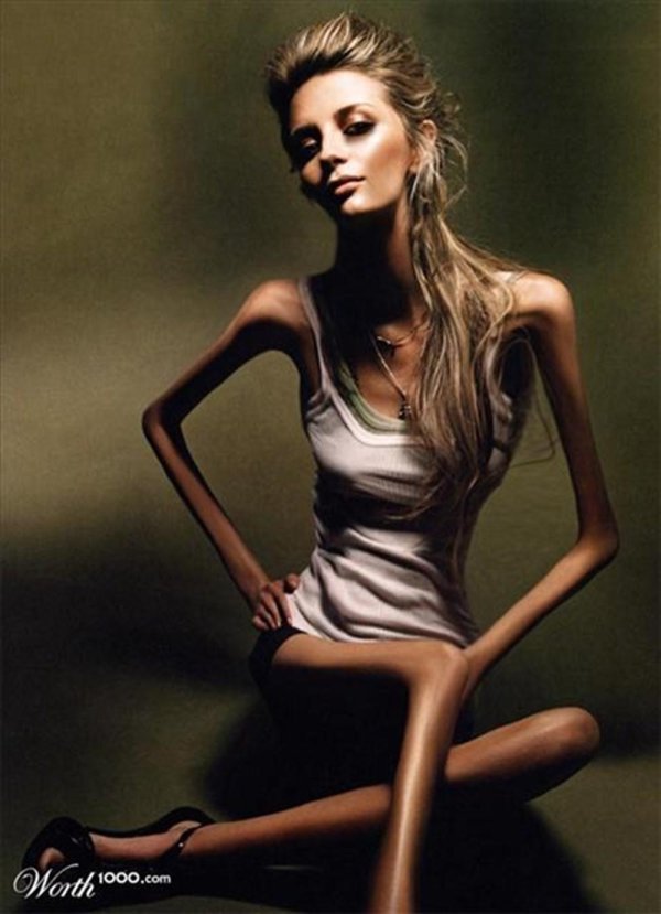 дистрофик девушка