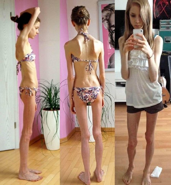 анорексия у детей