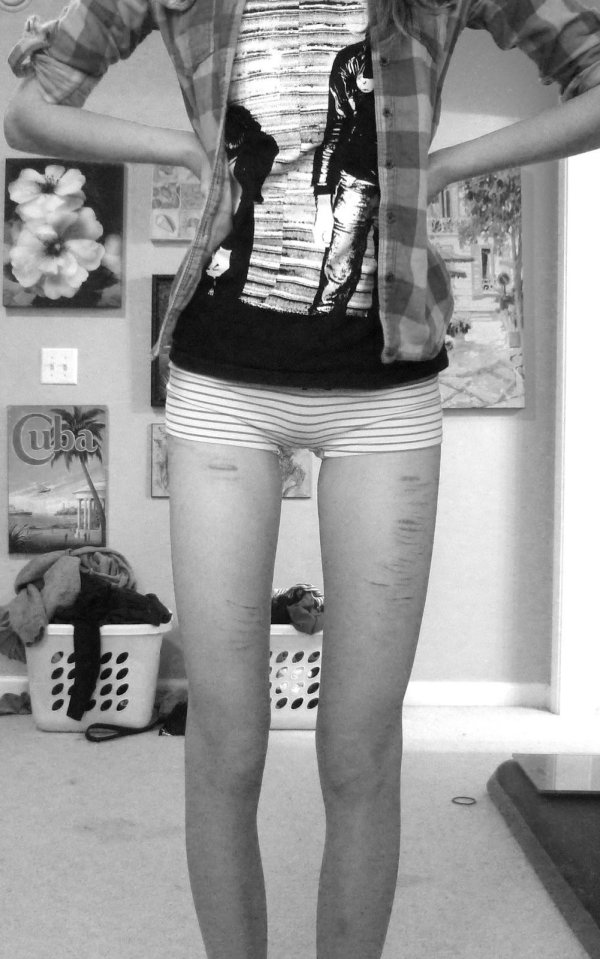 девушка анорексичка