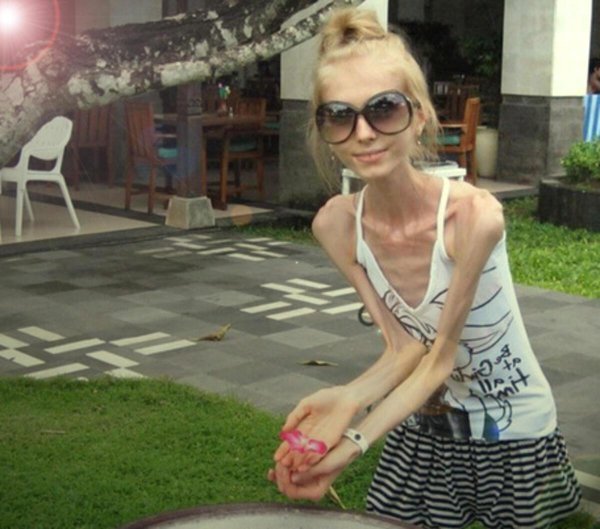 ксюша бубенко анорексия