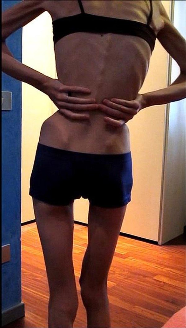 тело анорексия